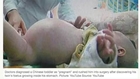 Boy Has Twin Surgically Removed From Inside Stomach